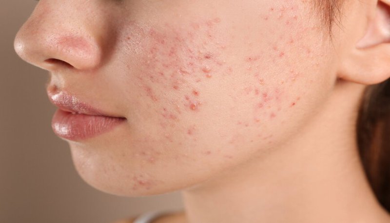 5 lầm tưởng về mụn trứng cá và chế độ ăn uống giảm mụn
