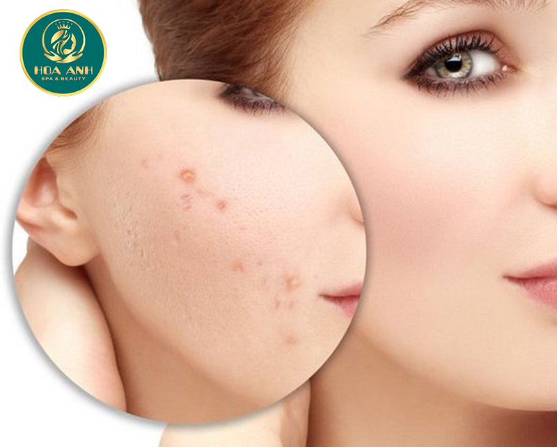 Cách tự nhiên giúp loại bỏ sẹo mụn