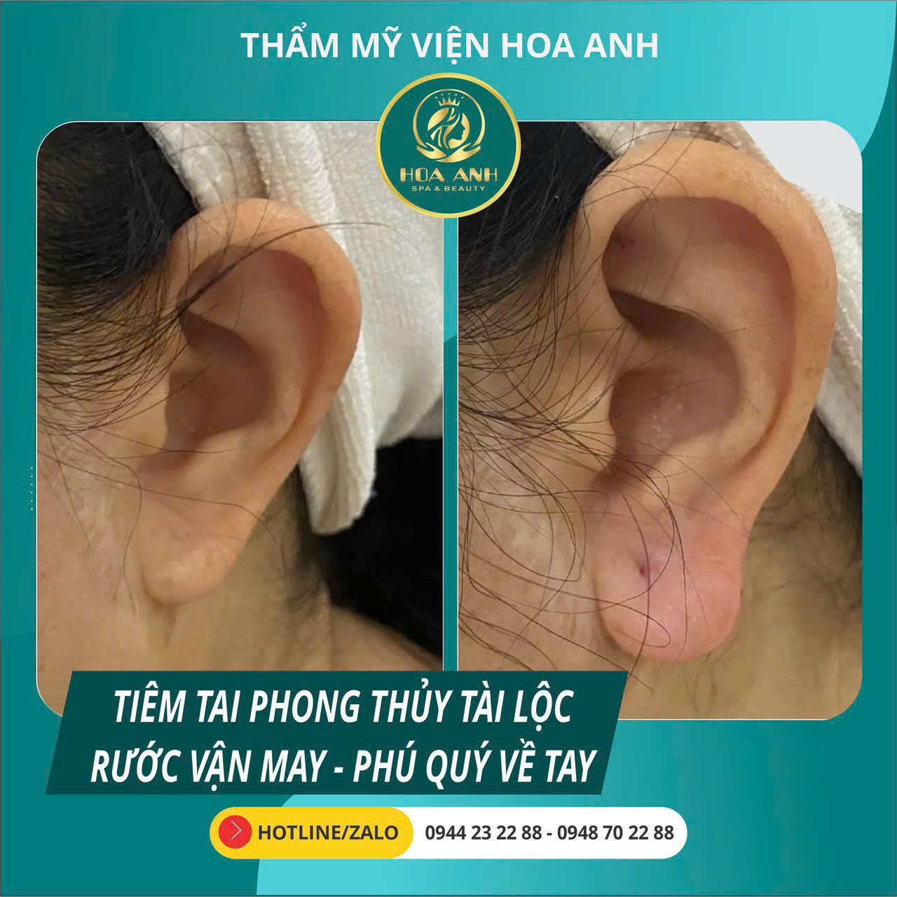 Dịch Vụ Tiêm Tai Tài Lộc – Bí Quyết Thu Hút May Mắn Và Kinh Doanh Phát Triển