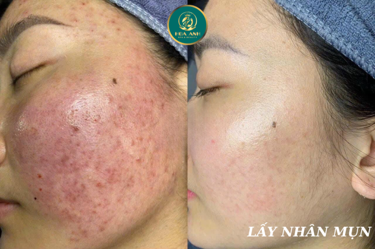 Điều Trị Mụn Không Chỉ Là Hết Mụn – Mà Là Hành Trình Hiểu Và Yêu Lại Làn Da Cùng Thẩm Mỹ Viện Hoa Anh