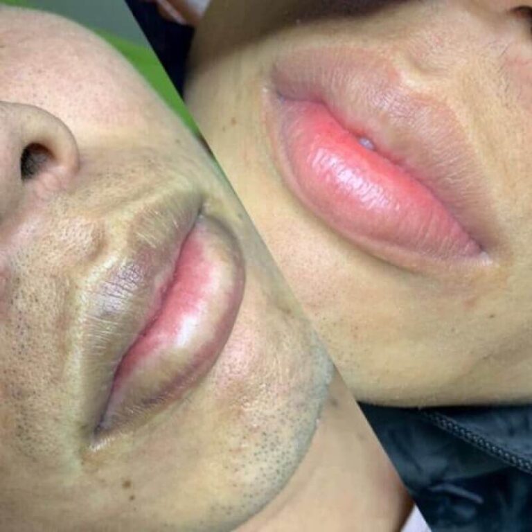 Khử Thâm Môi Nam , Đây Là Thời Điểm Vàng Để Làm Đẹp  Dịp Tết 