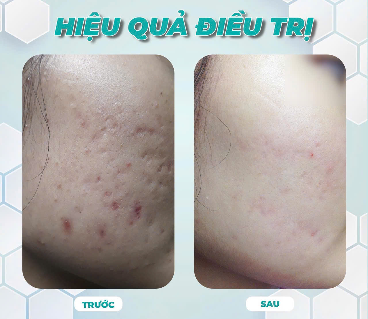 Điều Trị Mụn Trong Bao Lâu Thì Hết Hẳn? Chia Sẻ Từ Chuyên Gia Thẩm Mỹ Viện Hoa Anh