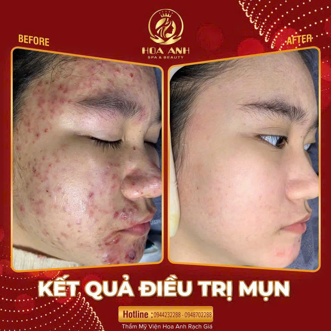 Chăm Sóc Da Sau Khi Lấy Nhân Mụn: Hướng Dẫn Chi Tiết & Hiệu Quả