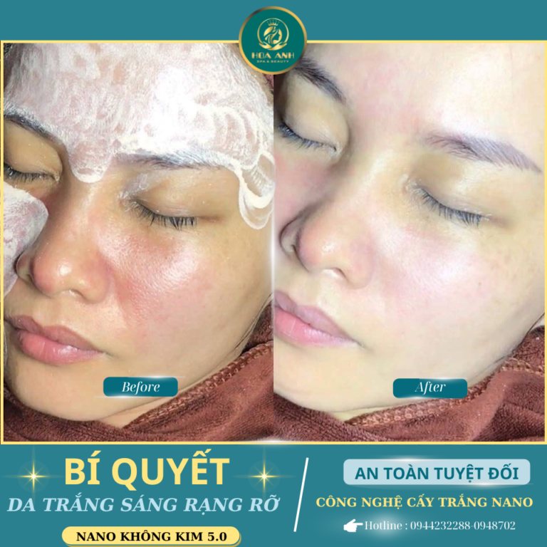 Cấy Trắng Da Mặt Có Bật Tone Ngay Sau Khi Cấy Không? Giải Đáp Từ Chuyên Gia