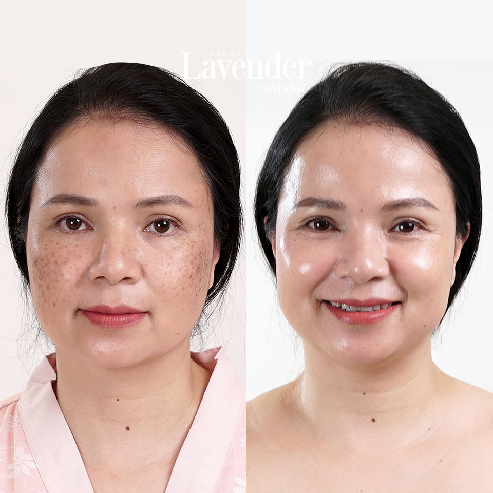 i nám mảng sâu – nám lâu năm – nám bẩm sinh