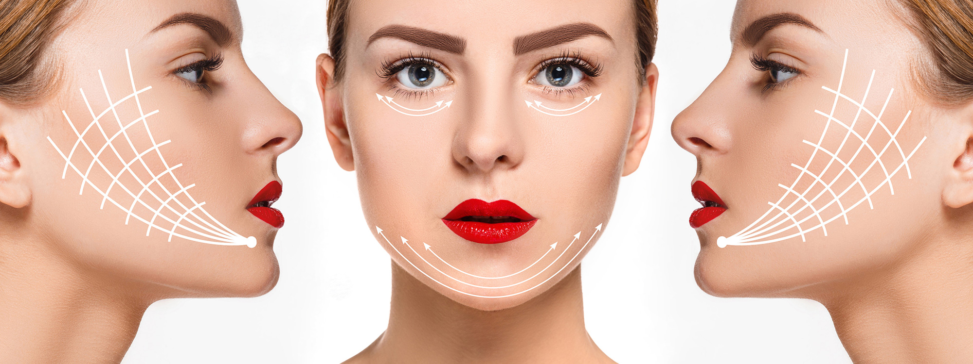 Căng da mặt bằng chỉ collagen – phương pháp làm đẹp sử dụng chỉ sinh học để gây phản ứng viêm tại chỗ