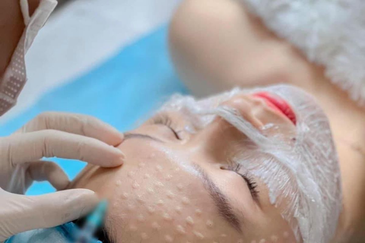 7. Chi Phí Thực Hiện Tiêm Mesotherapy