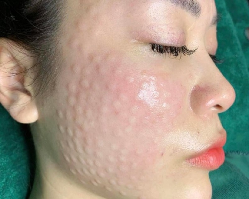 How long does it take for swelling to go away after meso injection? How